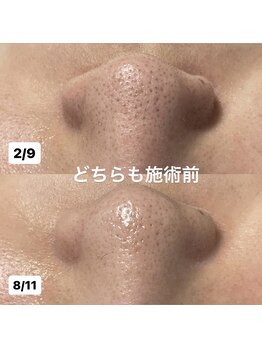 ミラーヴ(MERAVE)/施術とホームケアの効果