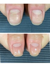 ルカロンネイル(Rukaron Nail)/凸凹爪