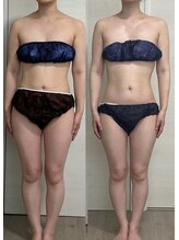 ヨルエステ(yoru aesthe)/【姿勢矯正、痩身、歪みとり】