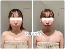 イデアルミー 大宮店(イデアルMe)/1回目施術前・3回目施術前