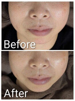 ミヨン ヨコハマ(Miyonne Yokohama)/LDM Aqua+小顔ヘッドスパ上大岡