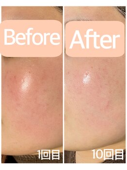 おうちサロン ミキ/BeforeAfterピーリング