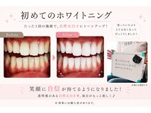ココホワイトニング(coco whitening)の雰囲気（症例 多数のホワイトニング 施術/つくば・つくばみらい・常総）