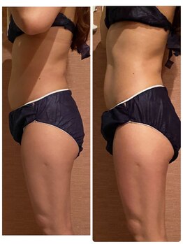 プレナスローズハート(PLENUS ROSE HEART)/気になる所を集中的に！