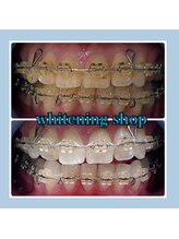 ホワイトニングショップ 堺東店/【ビフォーアフター】10回