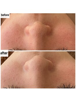 メナードフェイシャルサロン 岐阜茜部/ホワイトニングパック