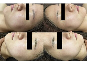 ラヴィアンローズ 泉店 (La vie en Rose)/イロンハーブピーリング