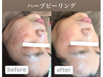 メンテ(MENTE)/ハーブピーリング