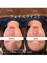 フェアリーフェイス 南森町店(Fairy Face)/南森町/小顔矯正&レモンボトル