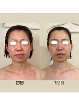 リーブル(LIBRE)/小顔コルギ　7回