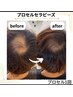 【プロセルセラピーズ】薄い毛・抜け毛改善都度 ¥42,000