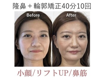ラプリ 大阪心斎橋店(Raplit)/隆鼻＋輪郭矯正40分10回
