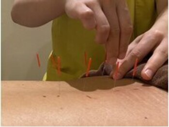 とんとん整骨院 鍼灸院 東武練馬/ 慢性腰痛・肩こりも鍼で改善