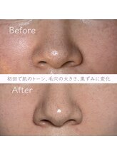 エービューティ(A.beauty)/長年の毛穴悩みに