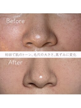 エービューティ(A.beauty)/長年の毛穴悩みに