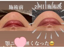 リツイート(ReTweet)/