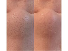 ダリア(Dahlia)/毛穴1回でここまで変化！