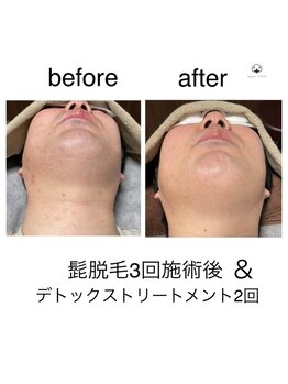 プライベートサロン コットン(COTTON)/ヒゲ脱毛×メンズフェイシャル