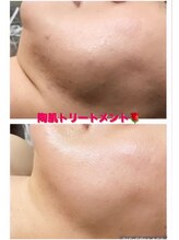 サロンデュヒャーク 志木駅前店(salon du ひゃーく)/ツヤツヤお肌に★