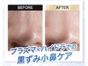 夏の汚れごっそり！ハイドラフェイシャル＆プラズマでつる肌幹細胞スプレー