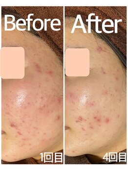 おうちサロン ミキ/BeforeAfterピーリング