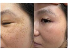 エムズビューティスタジオ エステ リラク 西川口店(M's Beauty Studio)/シミ改善