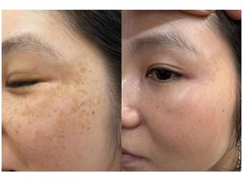 エムズビューティスタジオ エステ リラク 西川口店(M's Beauty Studio)/シミ改善
