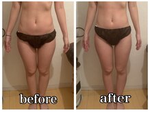 シェノン(CHAINON)/キャビテーション