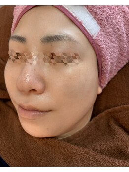 リシアン(Lisian)の写真/産毛・古い角質を優しく除去！肌の土台作りとターンオーバーを整え、卵肌へ◎