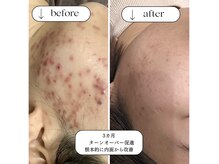 グロース鍼灸整骨院 豊浜院の雰囲気(【岡山県初】マロン美容鍼100本以上の鍼を使い根本改善☆)