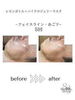 サロン エイトミー(salon 83)/【レモンボトル】before→after