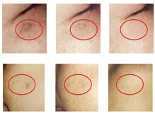 セラピエージ/お肌に優しいシミケア