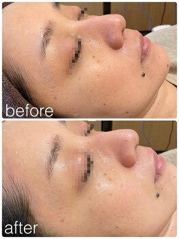 ベルシア ボディアンドアイラッシュ(Belsia)/韓国式美肌OHLハーブピーリング