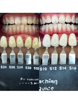 トウキョウスワーズ 池袋店(TOKYO SWRS)/#ホワイトニング #池袋 #渋谷