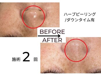 ベガ(Vega)/ハーブピーリングダウンタイム有