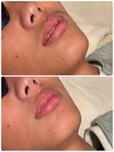 エステティックサロン縁/思春期男子のヒゲ脱毛