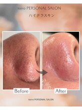 トイロ(toiro)/毛穴洗浄　ハイドラスキン