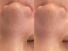 リラ(Lilas)/毛穴洗浄×ハーブ