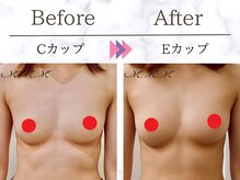 メディカルサロン エム エム エム 心斎橋本店(M.M.M)/【バストアップ例】　C→Eカップ