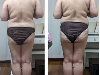 紬(TSUMUGI)/背中のお肉は整体リンパで取れる