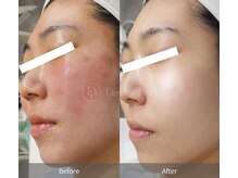 ハレアンド(Hare&)/ララピール越えダクトピール