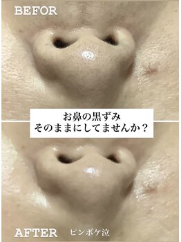 コルッソ(CoLusson.)/毛穴の黒ずみすっきり解消!