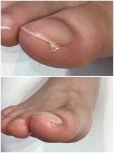 モアクリスタル(More Crystal)/巻き爪補正