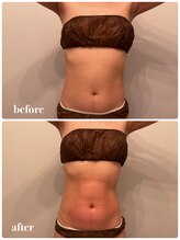 ウルラ(ULULA)/人気の脂肪冷却！