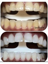 ホワイトニングセンター 大阪茨木店/高槻・茨木ホワイトニング