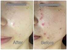 FJ/ニキビケアにも◎