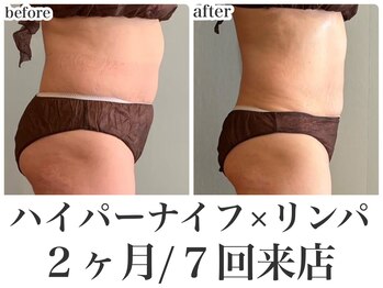 リミー 東大宮店(REME)/【ハイパーナイフ】背中お腹集中