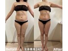 ヴィクシア(VIXIA)/痩身90分