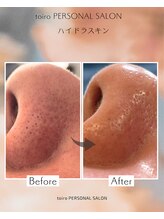 トイロ(toiro)/毛穴洗浄　ハイドラスキン