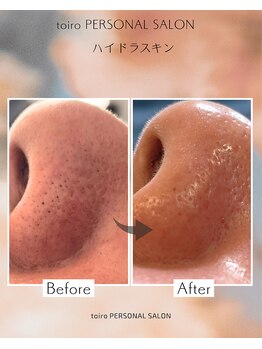 トイロ(toiro)/毛穴洗浄　ハイドラスキン